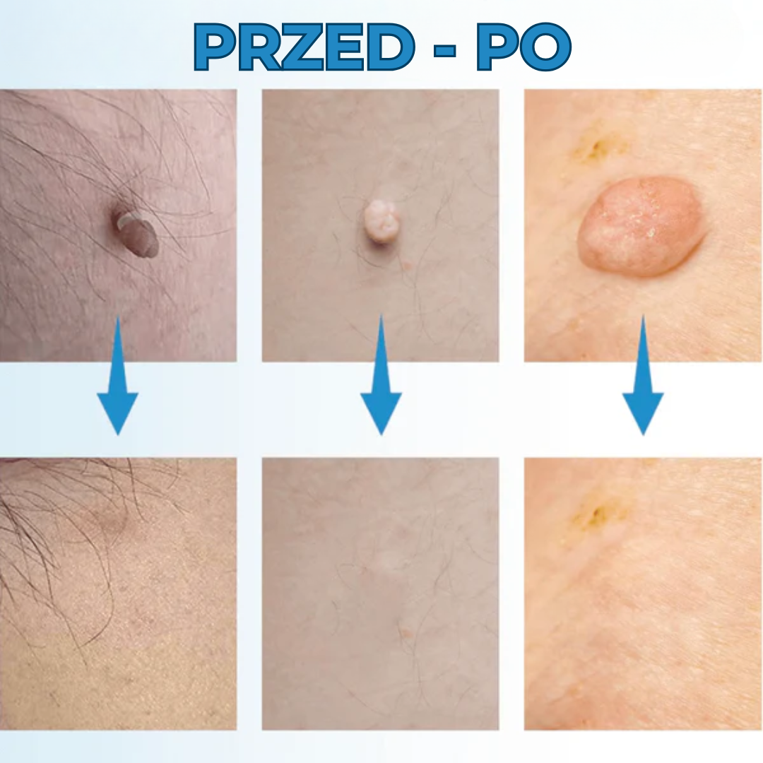 WartStop™ | Pożegnaj się z włókniakami – bez operacji i bez blizn!