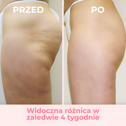 SkinSculpt™ | Usuń cellulit – Zobacz i poczuj różnicę już po kilku tygodniach