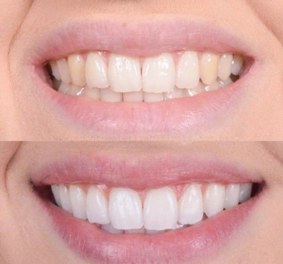 SmileBright™ - Rozjaśnij swój uśmiech, bez wysiłku. Wybielanie inspirowane kliniką.