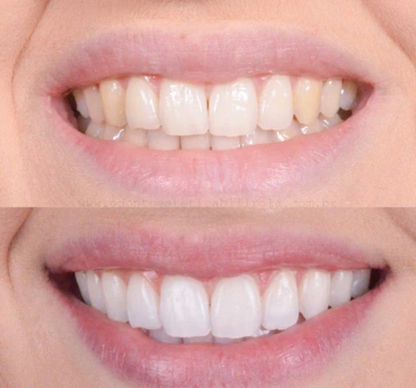 SmileBright™ - Rozjaśnij swój uśmiech, bez wysiłku. Wybielanie inspirowane kliniką.