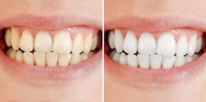 SmileBright™ - Rozjaśnij swój uśmiech, bez wysiłku. Wybielanie inspirowane kliniką.