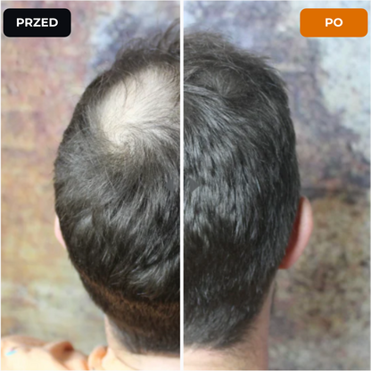 Lugaro | 💥 Pożegnaj się z przerzedzonymi włosami — Natychmiast! | Odkryj sekret pełniejszego, naturalnego wyglądu w kilka sekund