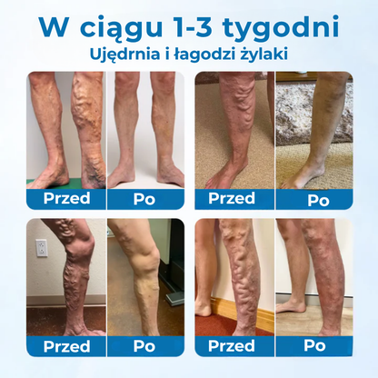 VitaVein™ | Naturalna ulga dla zmęczonych, ciężkich i opuchniętych nóg