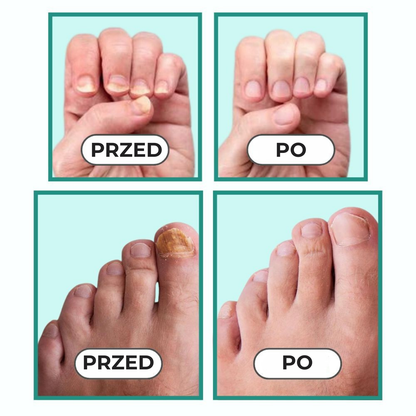 NailCure™ | Usuń grzybicę paznokci na dobre – zobacz efekty już w 3 tygodnie