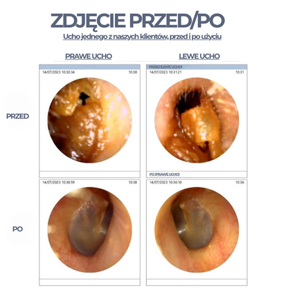 WaxClear™ – Inteligentne czyszczenie uszu z wykorzystaniem zaawansowanej technologii