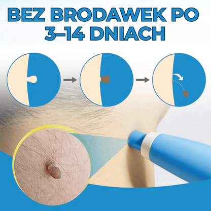 WartStop™ | Pożegnaj się z włókniakami – bez operacji i bez blizn!