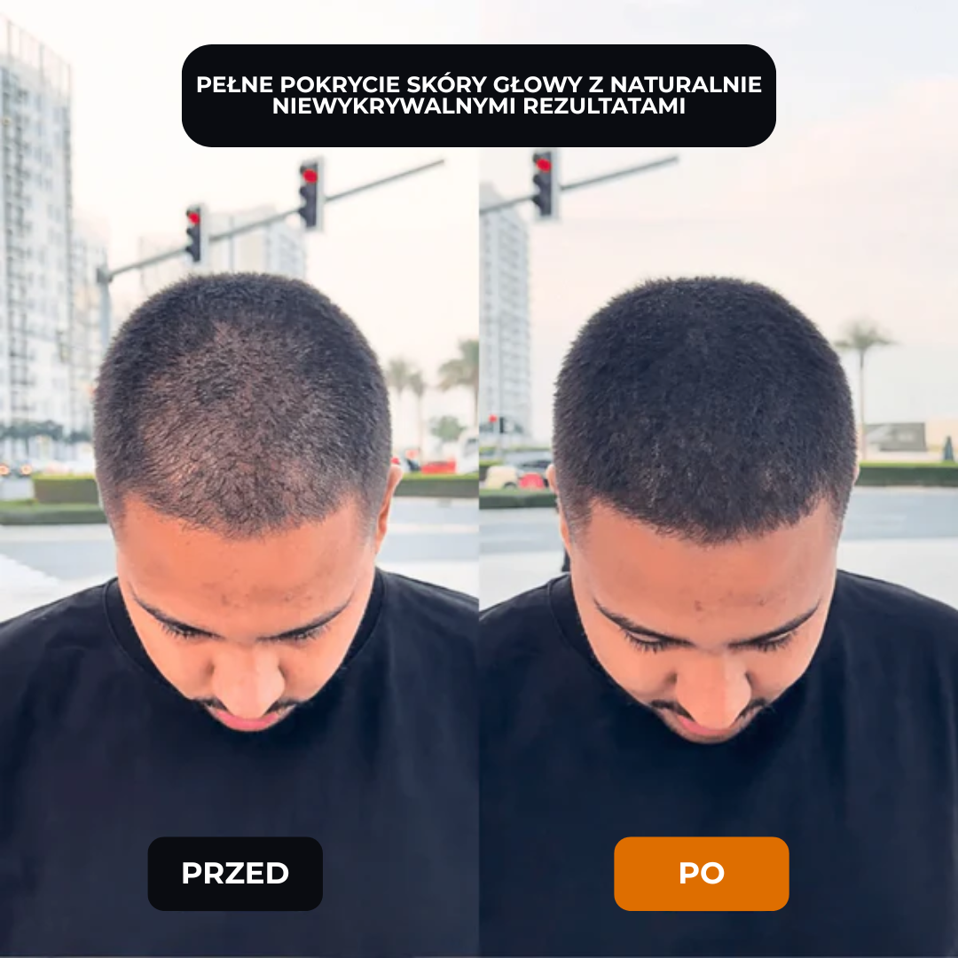 Lugaro | 💥 Pożegnaj się z przerzedzonymi włosami — Natychmiast! | Odkryj sekret pełniejszego, naturalnego wyglądu w kilka sekund