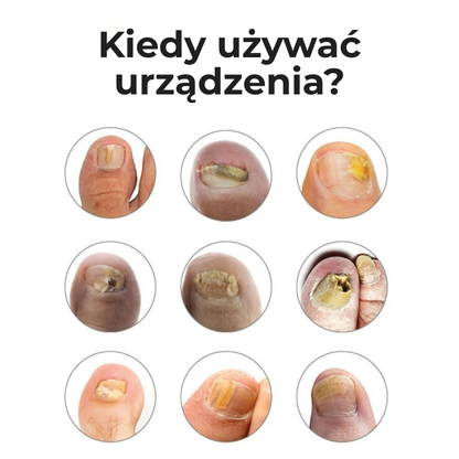 NailCure™ | Usuń grzybicę paznokci na dobre – zobacz efekty już w 3 tygodnie