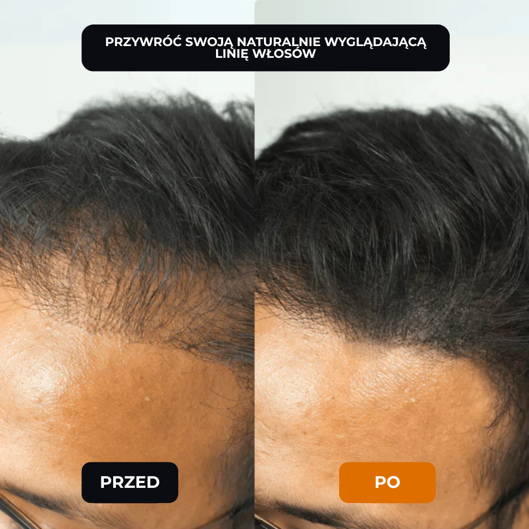 Lugaro | 💥 Pożegnaj się z przerzedzonymi włosami — Natychmiast! | Odkryj sekret pełniejszego, naturalnego wyglądu w kilka sekund