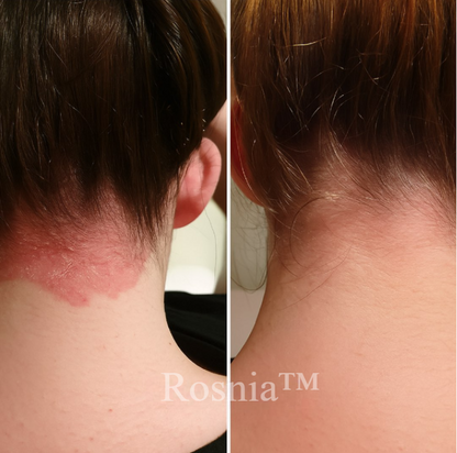 Rosnia™ | Premium Szczotka do Wzrostu Włosów i Pielęgnacji Skóry Głowy | W końcu – naturalny sposób na gęstsze, zdrowsze włosy 🌿✨